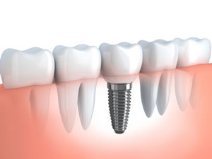 implant-dentistry